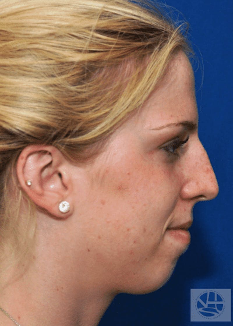 Rhinoplasty Before & After Gallery - Patient 55345701 - Image 7