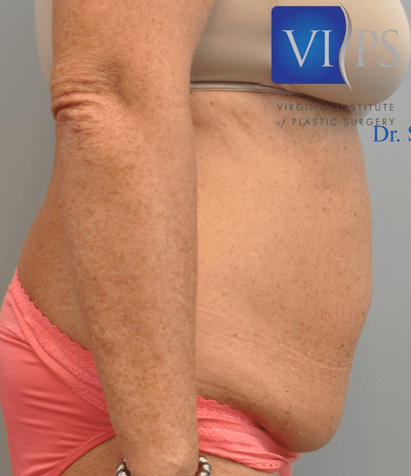 Tummy Tuck Before & After Gallery - Patient 55345706 - Image 5