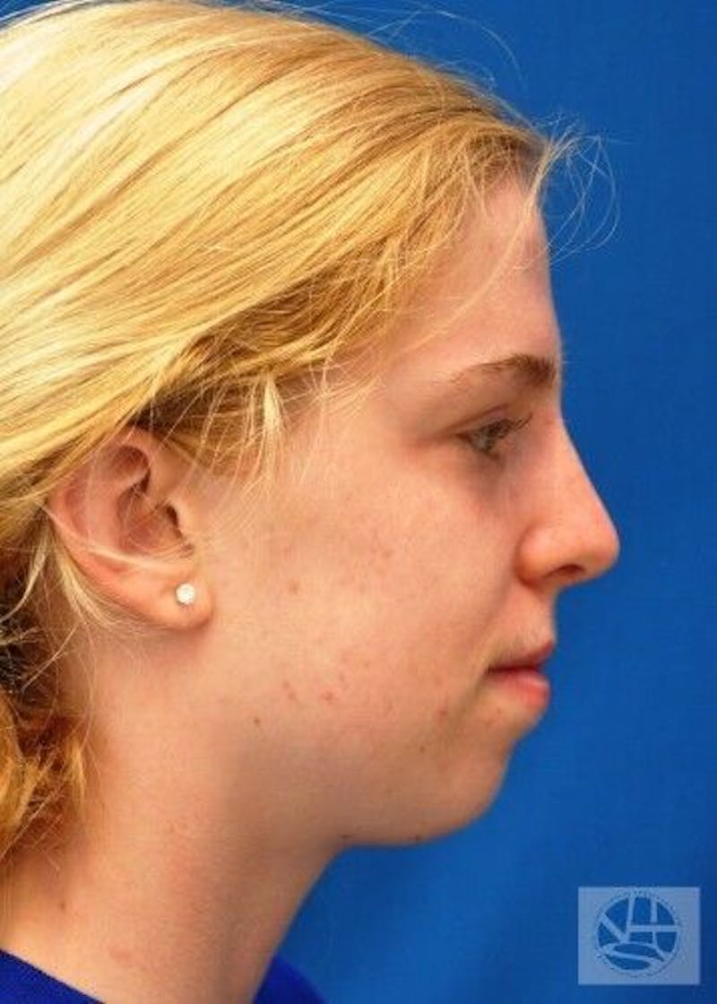Rhinoplasty Before & After Gallery - Patient 55345701 - Image 8