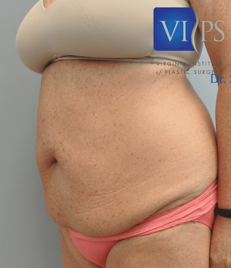 Tummy Tuck Before & After Gallery - Patient 55345706 - Image 7