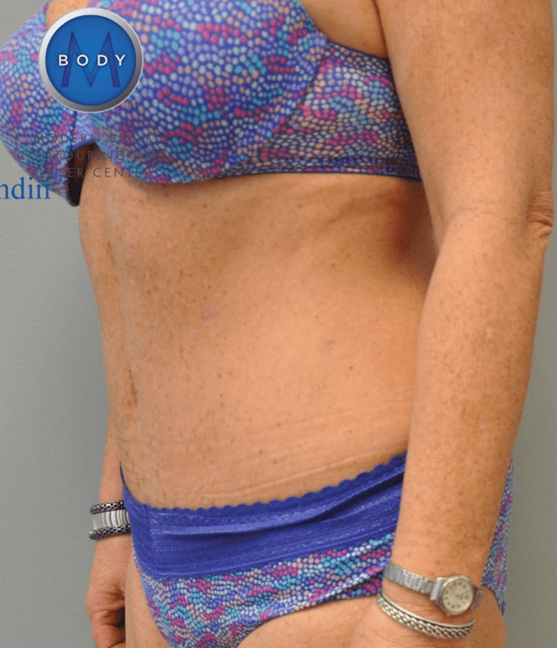 Tummy Tuck Before & After Gallery - Patient 55345706 - Image 8