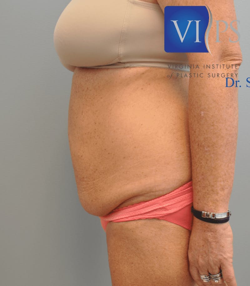 Tummy Tuck Before & After Gallery - Patient 55345706 - Image 9