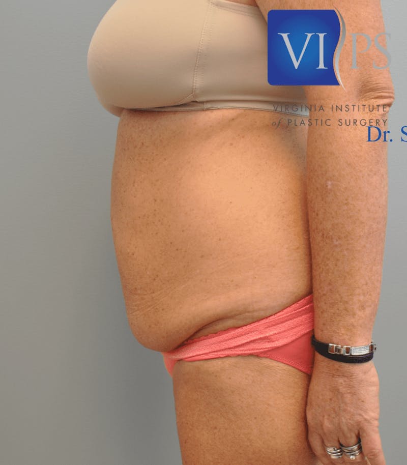 Tummy Tuck Before & After Gallery - Patient 55345706 - Image 9