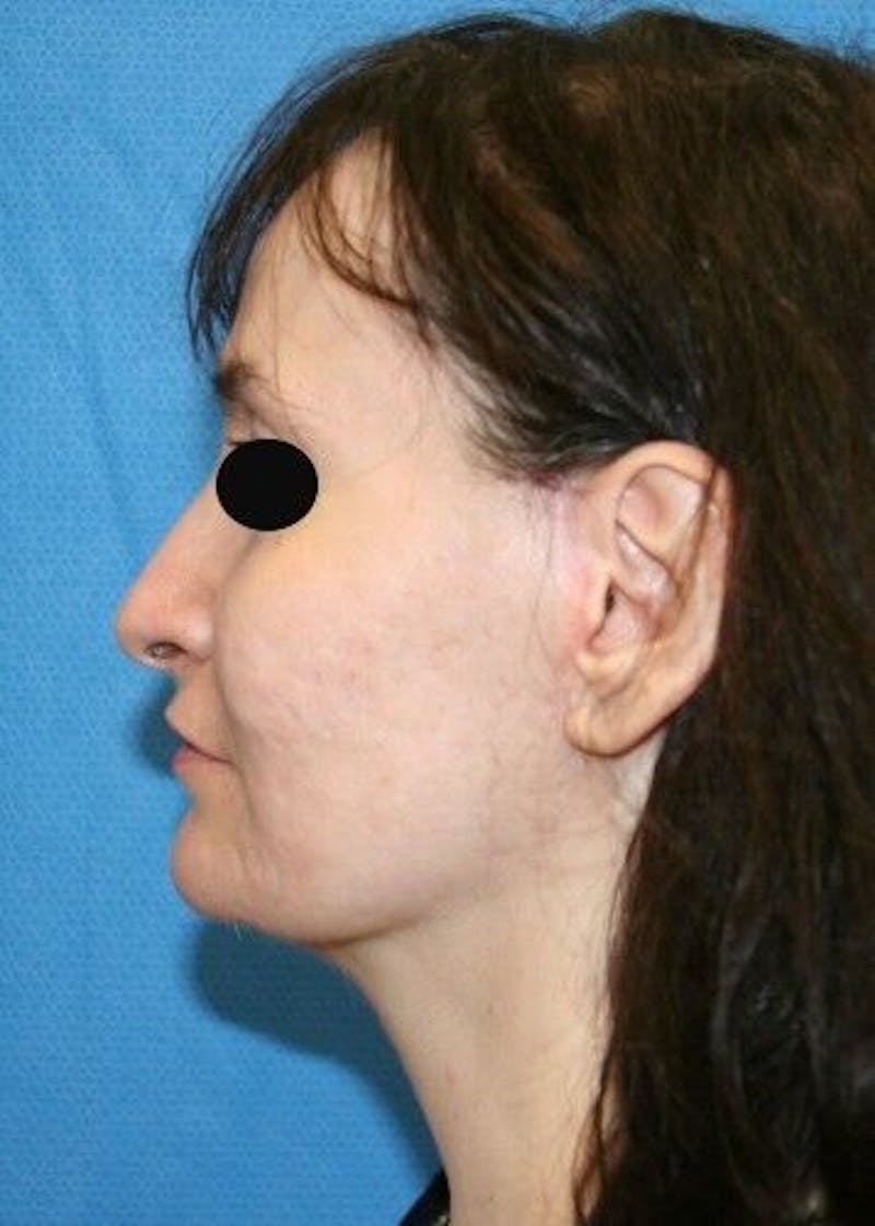 Rhinoplasty Before & After Gallery - Patient 55345704 - Image 6