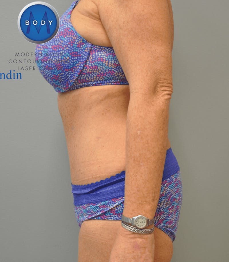 Tummy Tuck Before & After Gallery - Patient 55345706 - Image 10