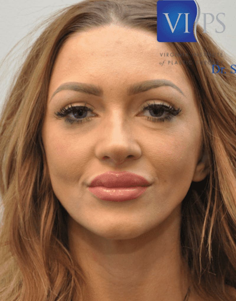 Rhinoplasty Before & After Gallery - Patient 55345707 - Image 1