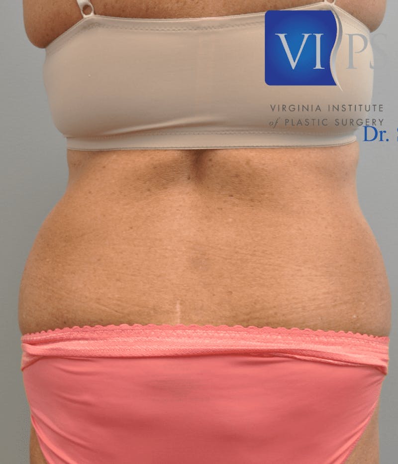 Tummy Tuck Before & After Gallery - Patient 55345706 - Image 11
