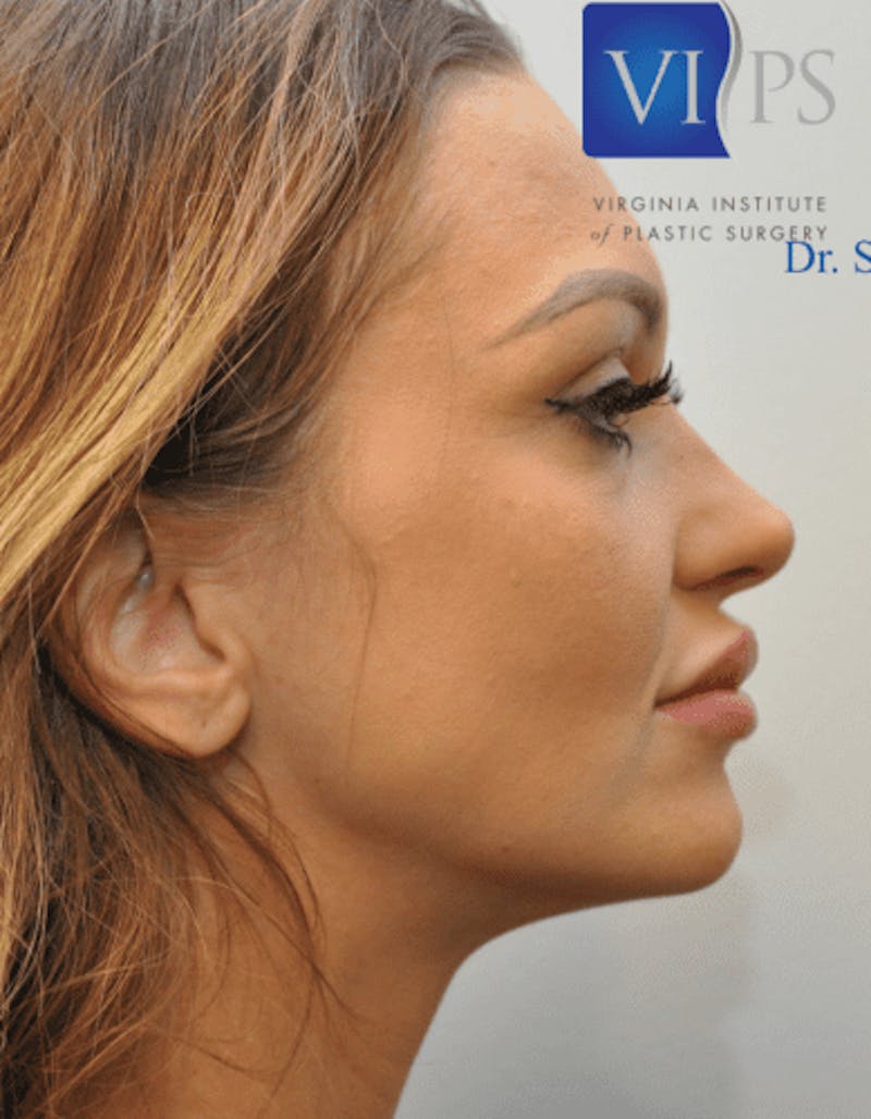 Rhinoplasty Before & After Gallery - Patient 55345707 - Image 3