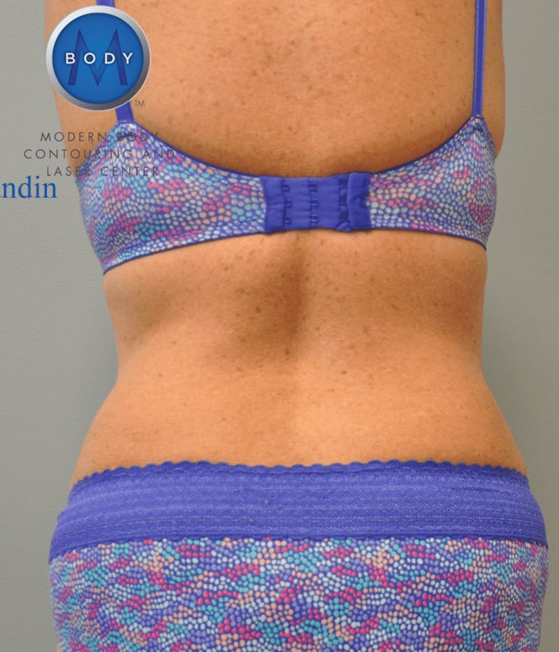 Tummy Tuck Before & After Gallery - Patient 55345706 - Image 12