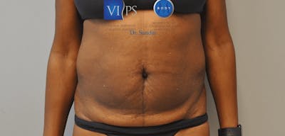 Tummy Tuck Before & After Gallery - Patient 55345719 - Image 1