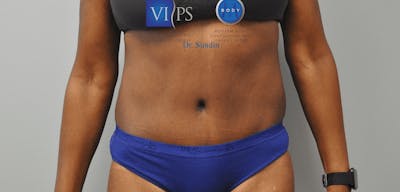 Tummy Tuck Before & After Gallery - Patient 55345719 - Image 2