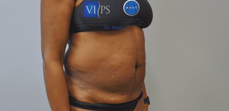 Tummy Tuck Before & After Gallery - Patient 55345719 - Image 3