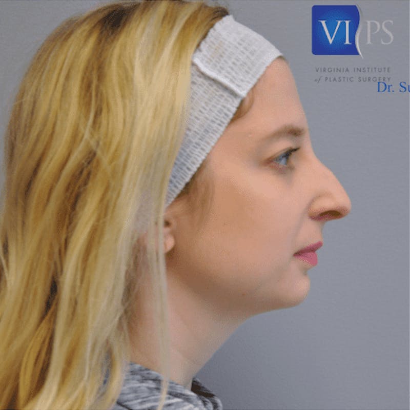 Rhinoplasty Before & After Gallery - Patient 55345717 - Image 3