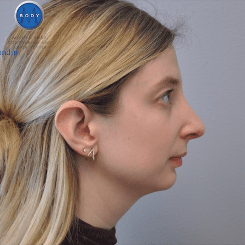 Rhinoplasty Before & After Gallery - Patient 55345717 - Image 4