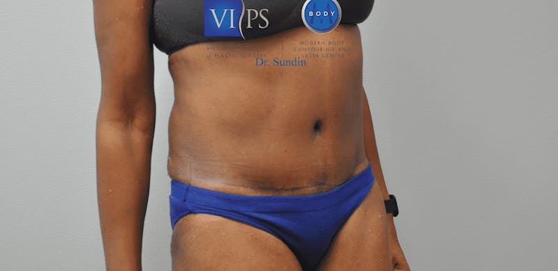 Tummy Tuck Before & After Gallery - Patient 55345719 - Image 4
