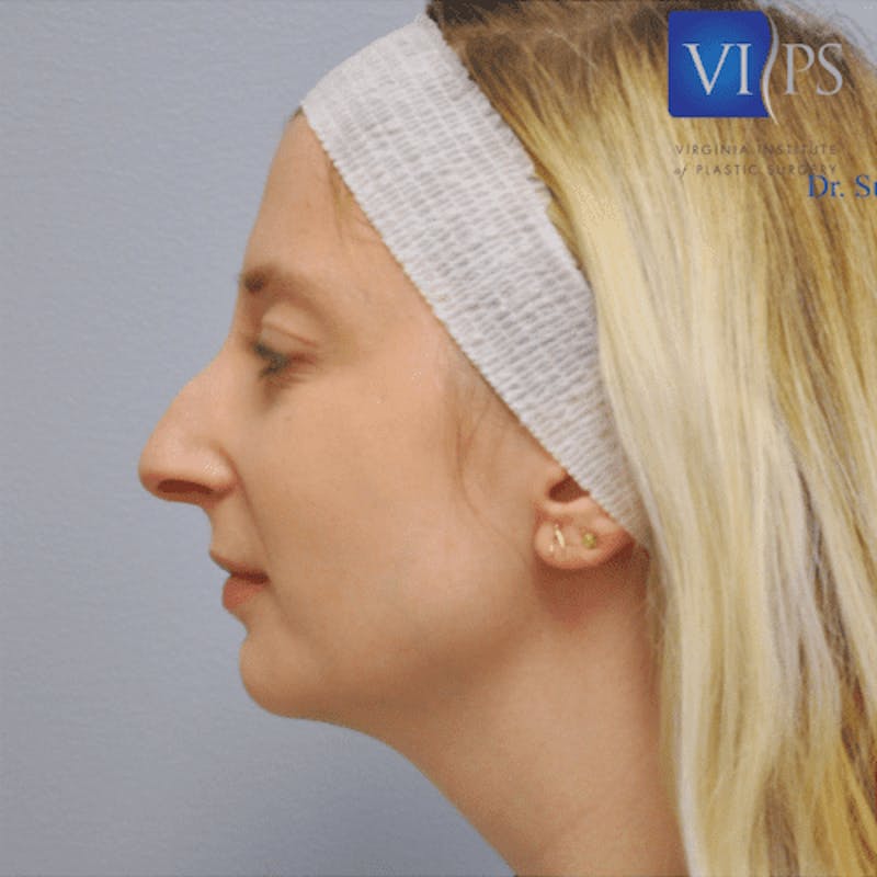 Rhinoplasty Before & After Gallery - Patient 55345717 - Image 5