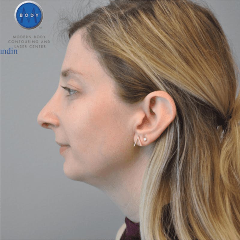 Rhinoplasty Before & After Gallery - Patient 55345717 - Image 6