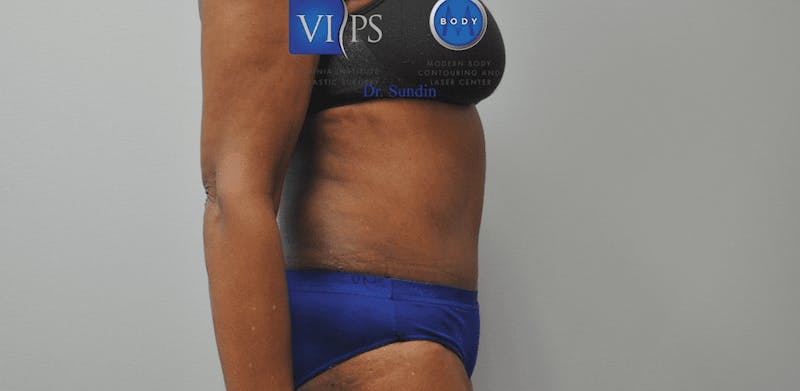 Tummy Tuck Before & After Gallery - Patient 55345719 - Image 6