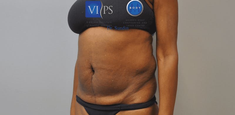 Tummy Tuck Before & After Gallery - Patient 55345719 - Image 7