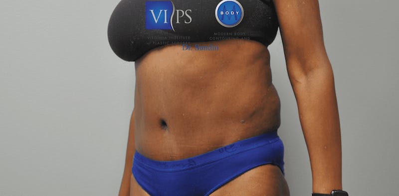 Tummy Tuck Before & After Gallery - Patient 55345719 - Image 8