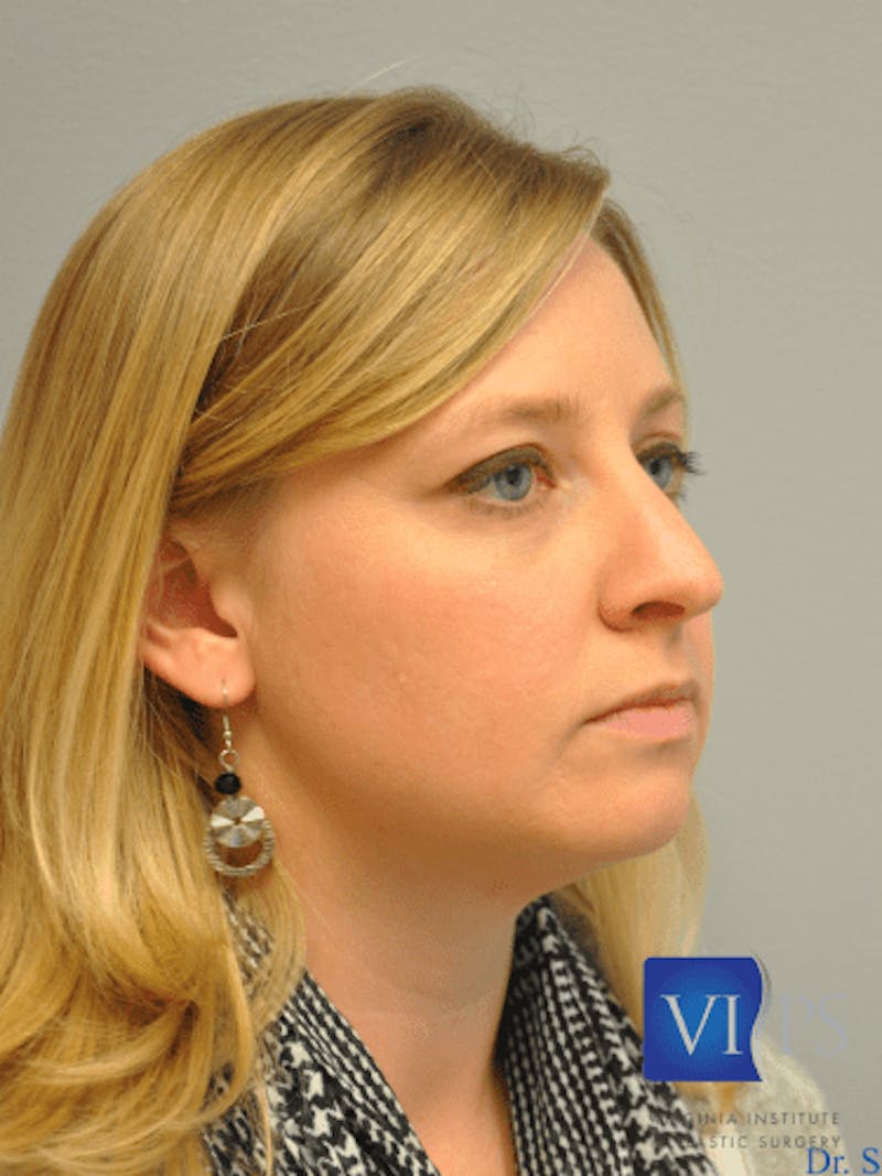 Rhinoplasty Before & After Gallery - Patient 55345720 - Image 3