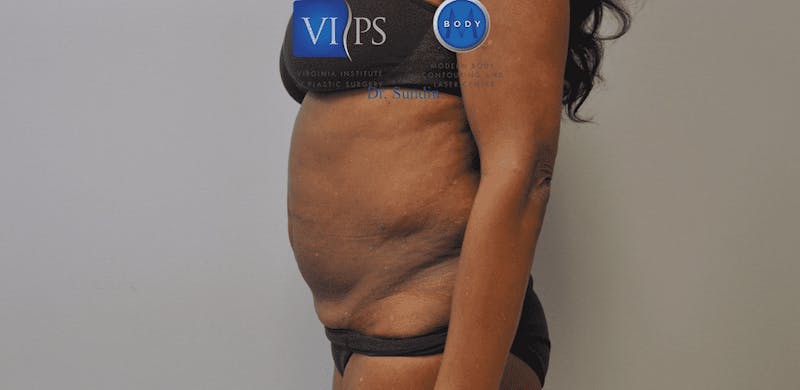 Tummy Tuck Before & After Gallery - Patient 55345719 - Image 9