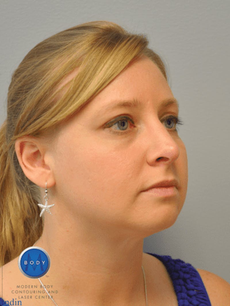 Rhinoplasty Before & After Gallery - Patient 55345720 - Image 4