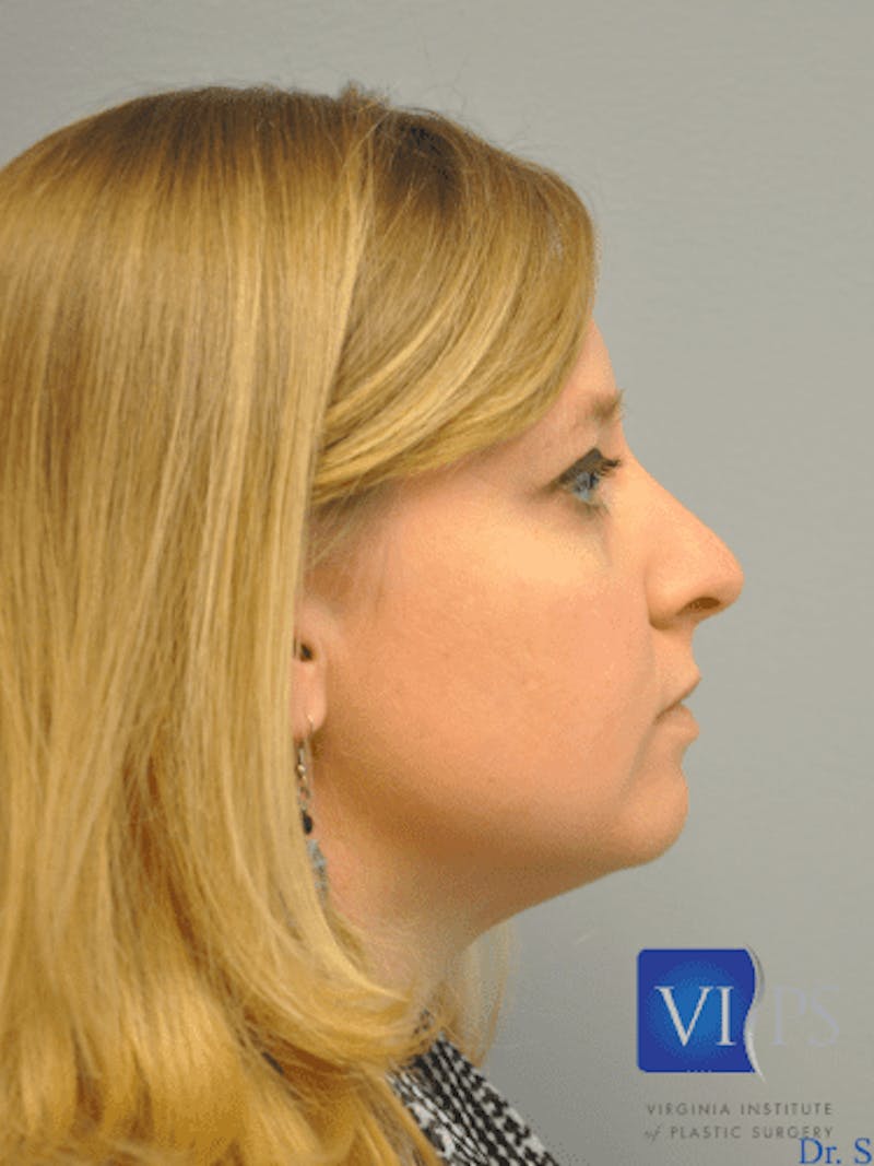 Rhinoplasty Before & After Gallery - Patient 55345720 - Image 5