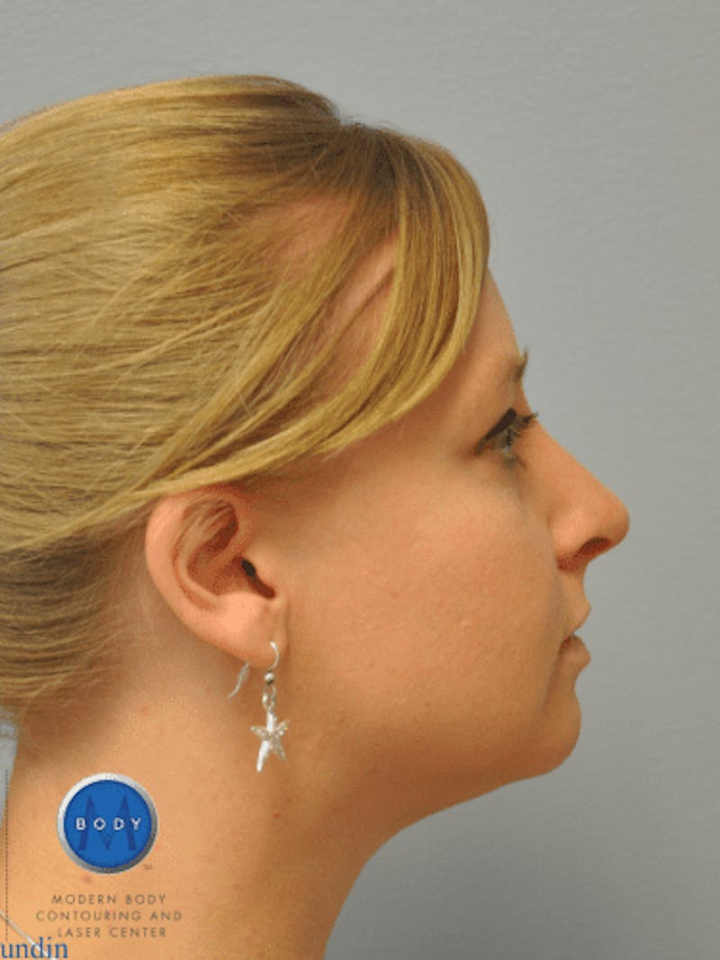Rhinoplasty Before & After Gallery - Patient 55345720 - Image 6