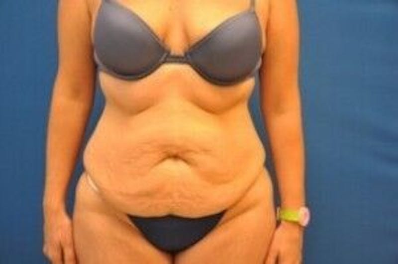 Tummy Tuck Before & After Gallery - Patient 55345735 - Image 1