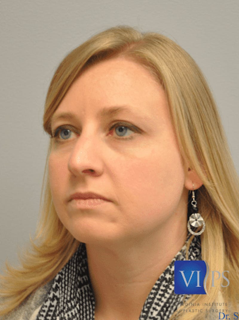 Rhinoplasty Before & After Gallery - Patient 55345720 - Image 7