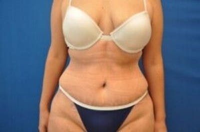 Tummy Tuck Before & After Gallery - Patient 55345735 - Image 2