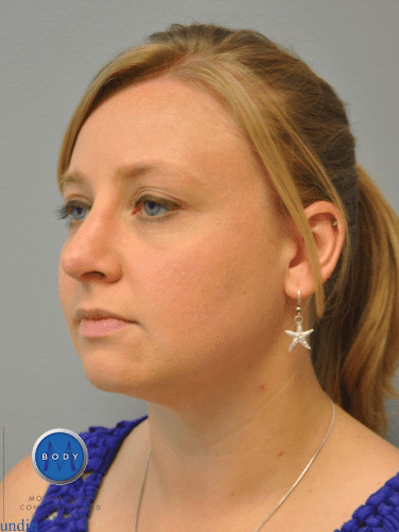 Rhinoplasty Before & After Gallery - Patient 55345720 - Image 8