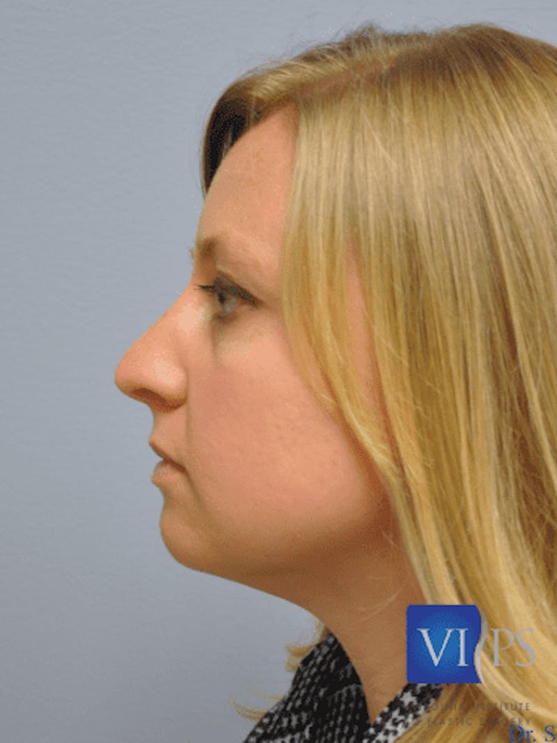 Rhinoplasty Before & After Gallery - Patient 55345720 - Image 9