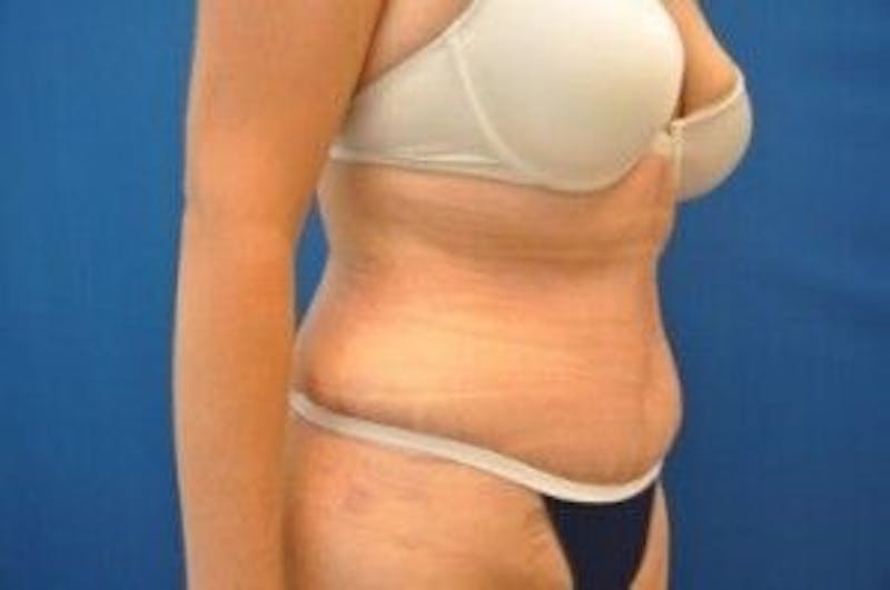 Tummy Tuck Before & After Gallery - Patient 55345735 - Image 4