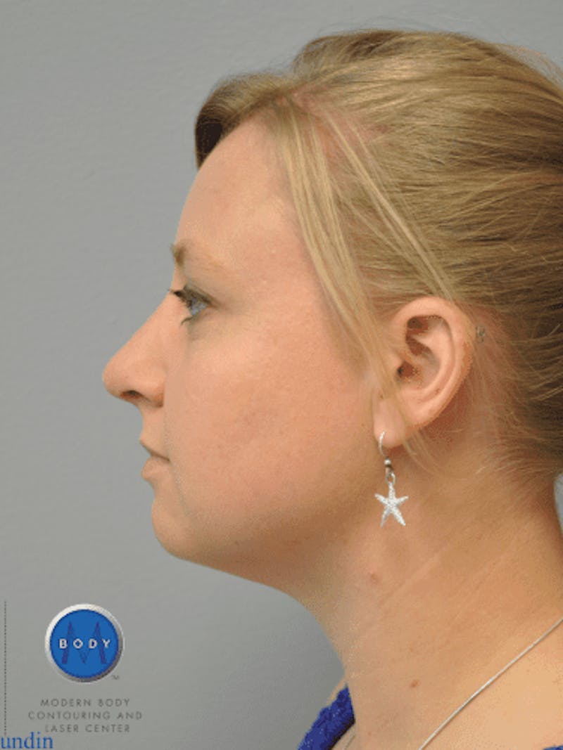 Rhinoplasty Before & After Gallery - Patient 55345720 - Image 10