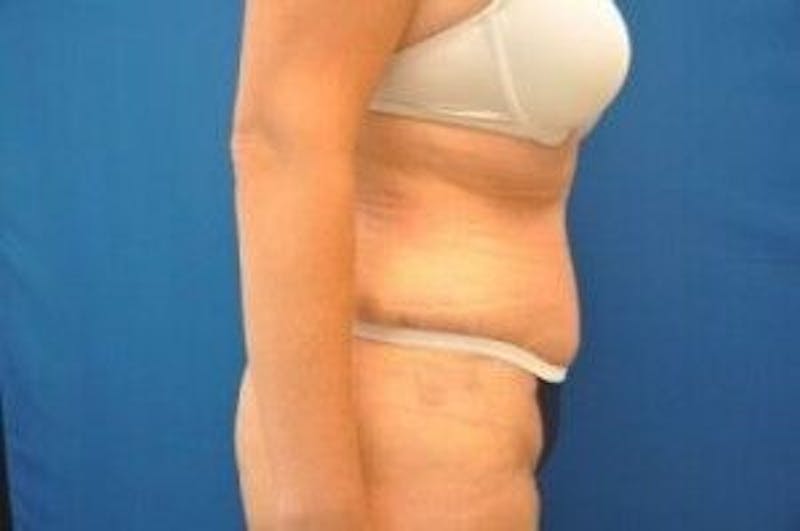 Tummy Tuck Before & After Gallery - Patient 55345735 - Image 6