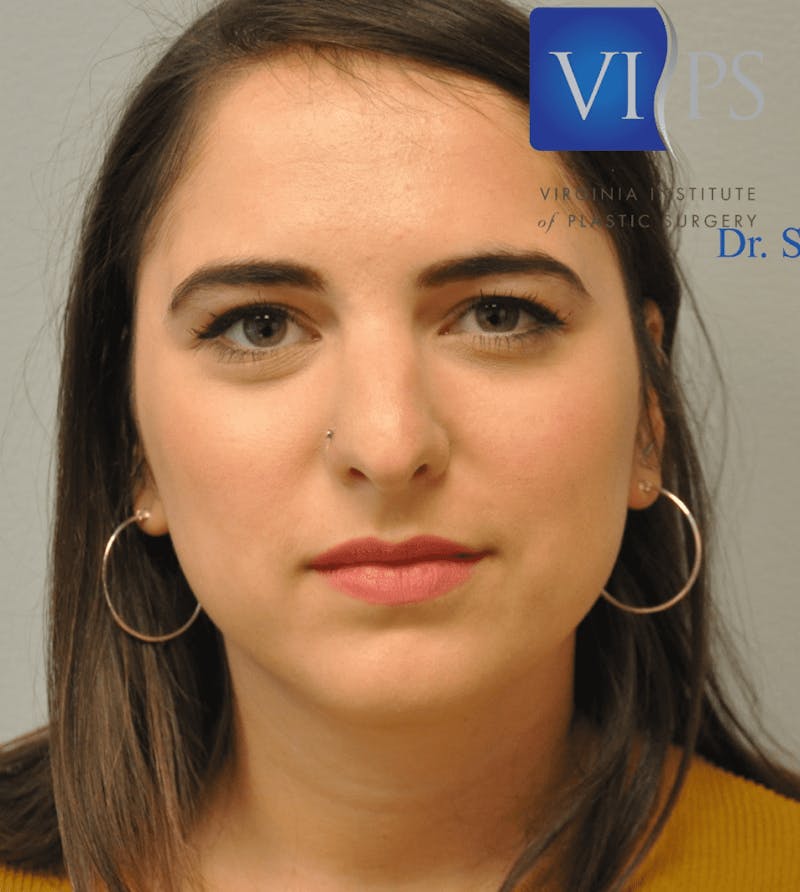 Rhinoplasty Before & After Gallery - Patient 55345742 - Image 1