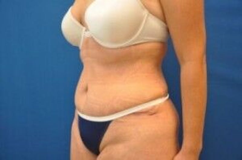 Tummy Tuck Before & After Gallery - Patient 55345735 - Image 8