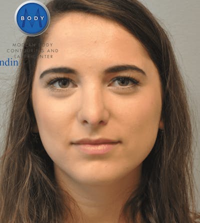 Rhinoplasty Before & After Gallery - Patient 55345742 - Image 2