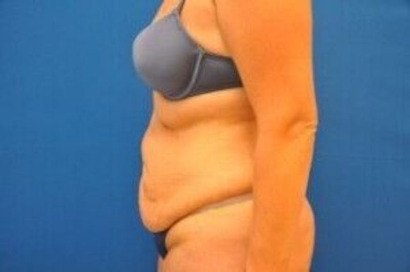 Tummy Tuck Before & After Gallery - Patient 55345735 - Image 9