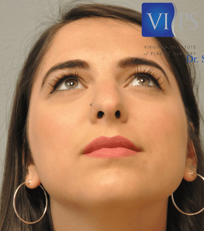 Rhinoplasty Before & After Gallery - Patient 55345742 - Image 3