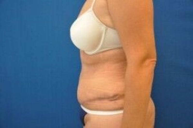 Tummy Tuck Before & After Gallery - Patient 55345735 - Image 10