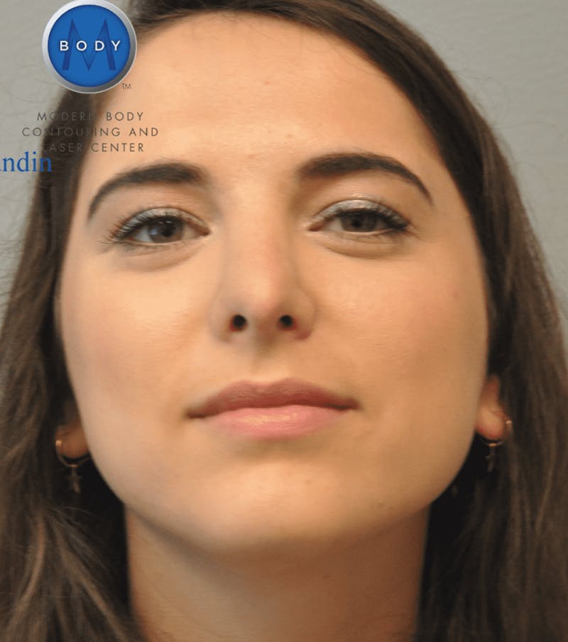 Rhinoplasty Before & After Gallery - Patient 55345742 - Image 4