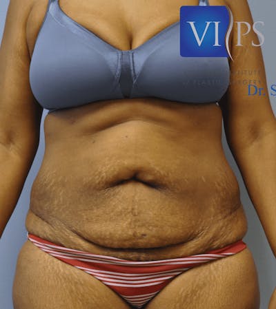 Tummy Tuck Before & After Gallery - Patient 55345739 - Image 1