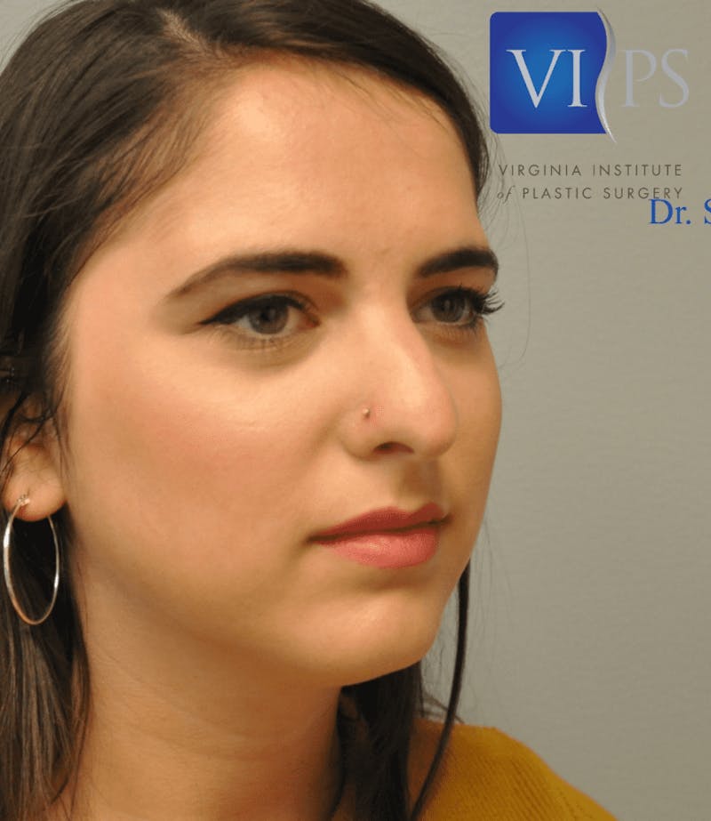 Rhinoplasty Before & After Gallery - Patient 55345742 - Image 5