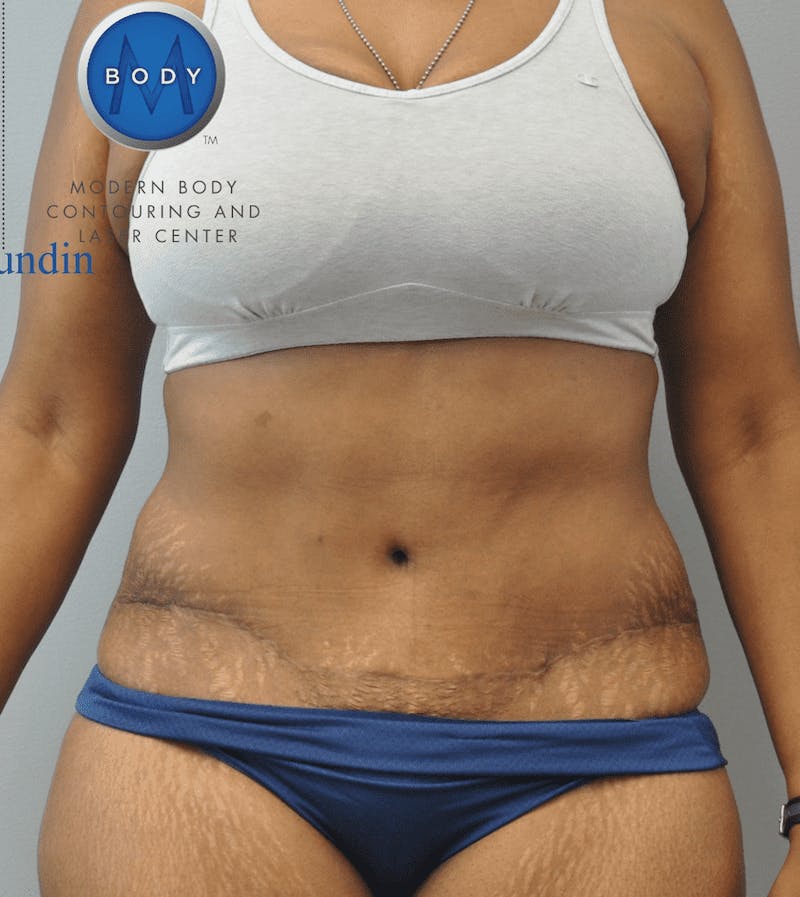 Tummy Tuck Before & After Gallery - Patient 55345739 - Image 2