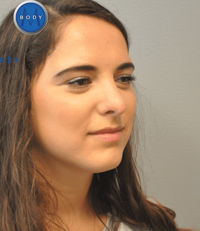 Rhinoplasty Before & After Gallery - Patient 55345742 - Image 6