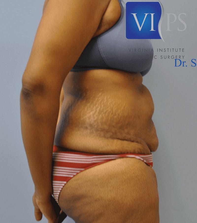 Tummy Tuck Before & After Gallery - Patient 55345739 - Image 3