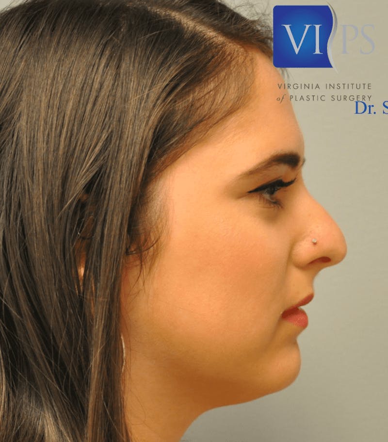 Rhinoplasty Before & After Gallery - Patient 55345742 - Image 7